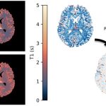 There are two slices of brains showing differences in quantitative T1 between MP2RAGE and multi-TI inversion recovery. A patch-based correction model reduces the relative value.